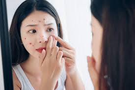 Panduan Memilih Skincare untuk Menghilangkan Jerawat